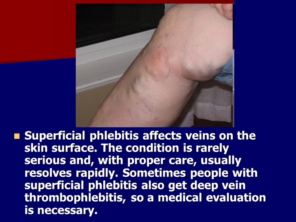 Superficial phlebitis affects veins on the skin surface. The condition is rarely serious and,